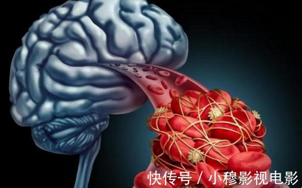 鱼类|五十岁以后,进入脑梗高发期,这4种食材少碰,一种肉或可多吃