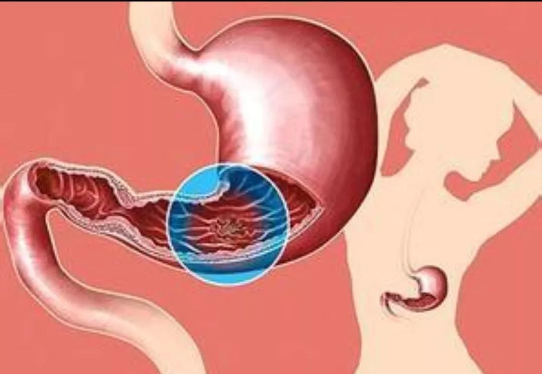 胃病|胃病“三分治七分养”,该如何养?胃黏膜损伤不吃药能自己修复?