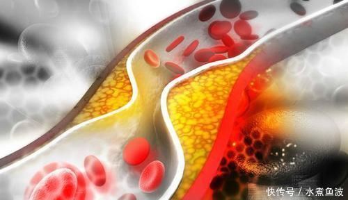 血管堵塞,身体会有这5种感觉!早发现早检查,不能拖