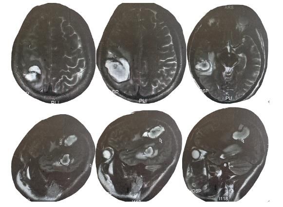 寄生虫|头皮发麻！男子吃这个东西当药引，结果身体里长满寄生虫！