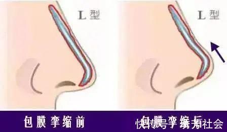 鼻尖|隆鼻后假体要定期更换吗？出现这些情形就该更换假体了！
