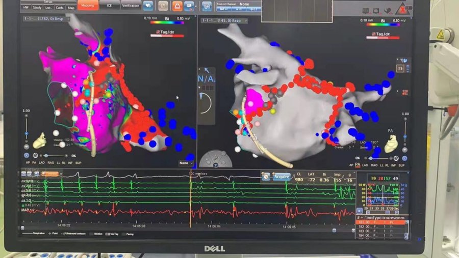 导管|让心肌喝酒,解顽固心疾—Marshall韧带消融解除顽固房颤