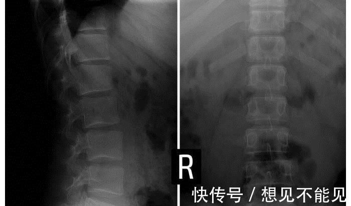 骨骼|78岁骨科医生：骨疏松不可怕，常做这3件事，骨骼或会慢慢变强