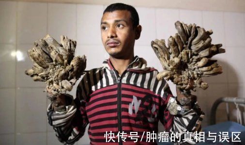 hpv感染|好消息，国内男性HPV疫苗来袭，一文告诉你为啥男性也要打疫苗？