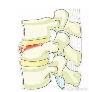 微创|骨质疏松性椎体压缩骨折需要治疗吗？