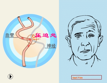 天敌|爱美人士的“天敌”:偏爱女性朋友的面肌痉挛