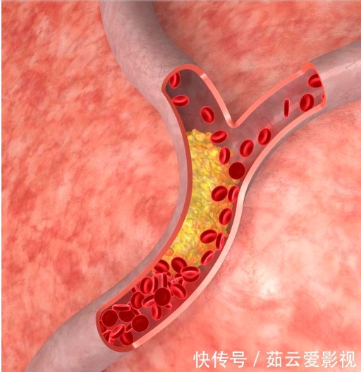 颈动脉狭窄|颈动脉斑块如何清除？医生讲的清清楚楚：不同斑块不同方法