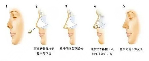 攻略 美鼻攻略|耳软骨隆鼻恢复期多久?注意事项+术后护理盘点!