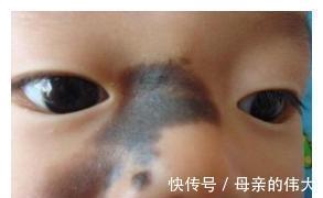 赵女士|胎记：最喜欢3种孕妇，孕期常做这些事，难看的胎记就会找上宝宝