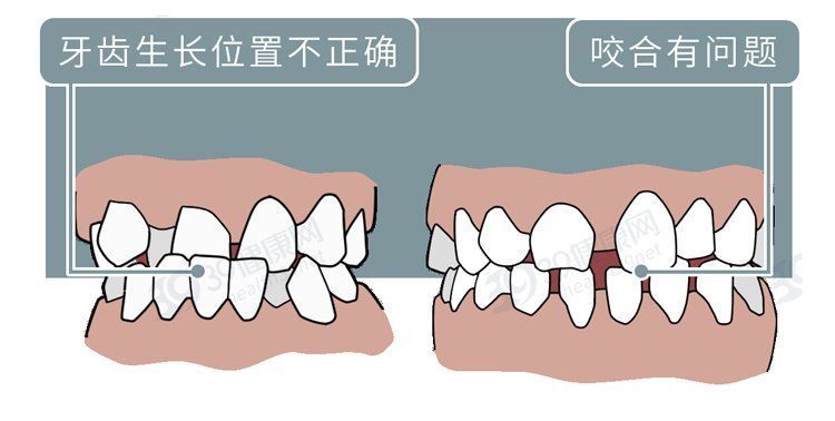 矫正|为什么只要戴牙套，牙齿就可以恢复得很整齐？生动展示矫正过程