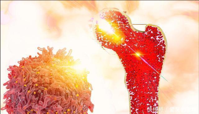 水煮蛋|骨疏松是因水煮蛋吃多了?骨科:想要骨头好,3种食物也尽量少吃