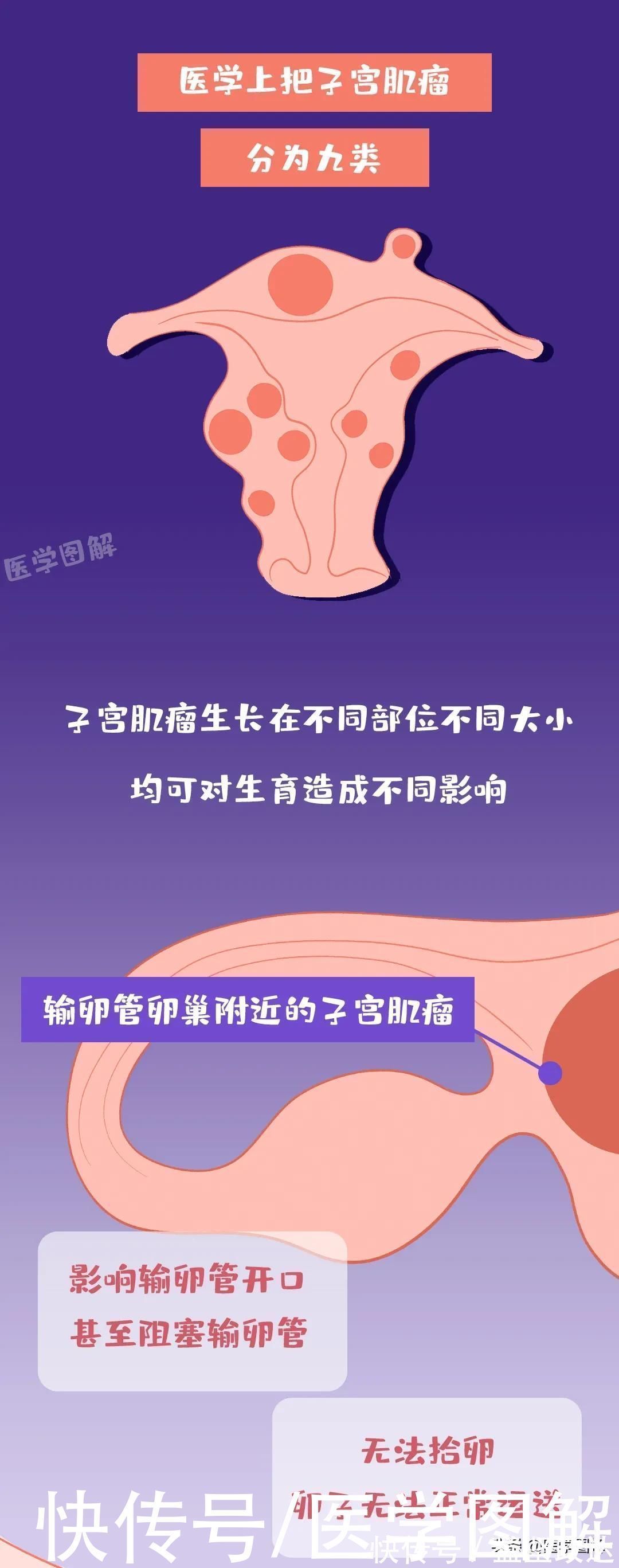 医学|为什么有的子宫肌瘤没有事,有的就会让人不孕不育丨医学图解