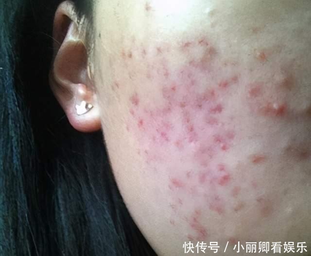  痘痘|脸上痘痘顽固清除不了？教你5招，快速赶走痘痘，皮肤光滑细腻！