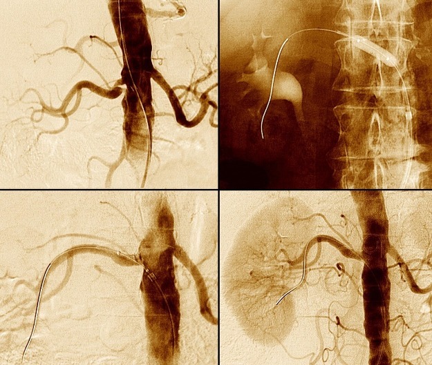 患者|写给高血压患者的信:如果您血压控制不佳,请看此文