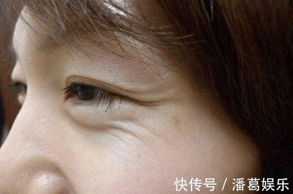 小拉皮 面部拉皮王小民教授:你要悄悄逆生长,然后惊艳所有人!