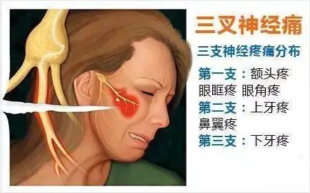 发作|三叉神经痛发作？！潍坊市人民医院专家教您如何应对