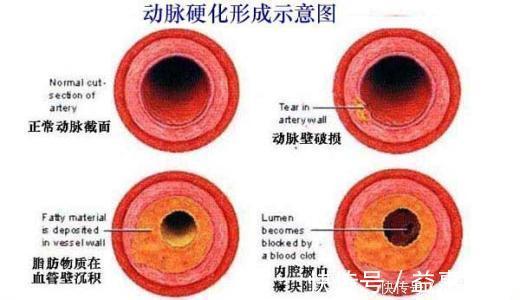 夹层|专家提醒：年轻人瑜伽运动不当容易造成中风！