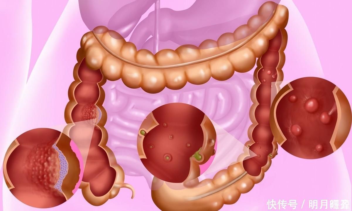 临床研究|提醒身体长出这3种息肉,一定要及时切掉,尤其第二种,拖不得