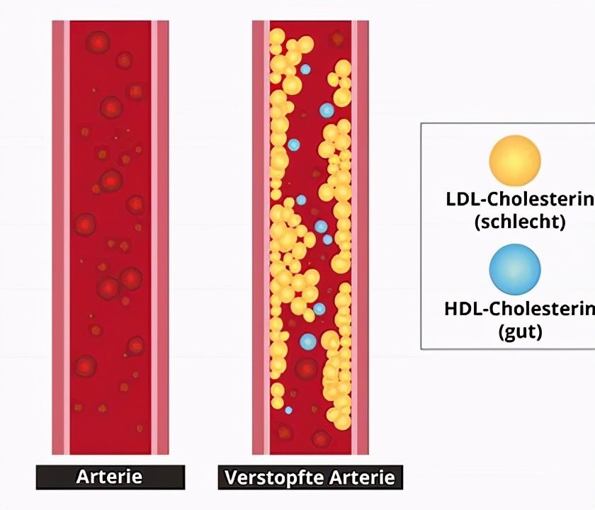 低密度脂蛋白胆固醇|低密度脂蛋白胆固醇升高，是不是血管堵塞了？医生为您讲明白