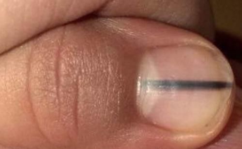 4种指甲的变化,3种情况可要注意,你平时关注过指甲吗