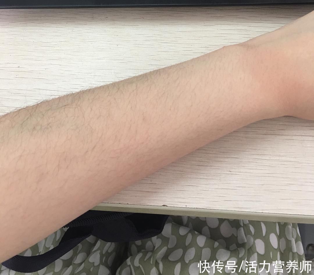 身体不适|为什么有些人汗毛是白的,还有些人是黑的?哪种视为正常现象?