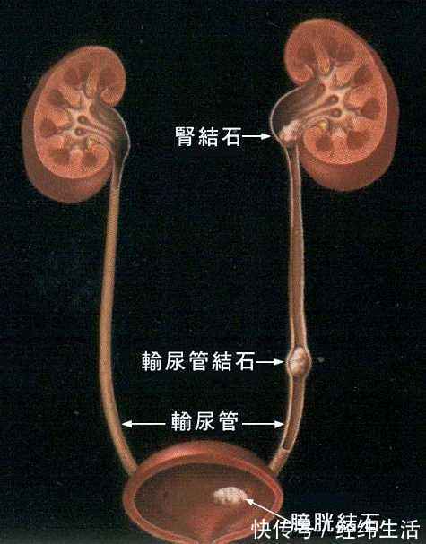 尿路结石|有一种病平时不疼,发作的时候比生孩子还疼,好发于年轻男性
