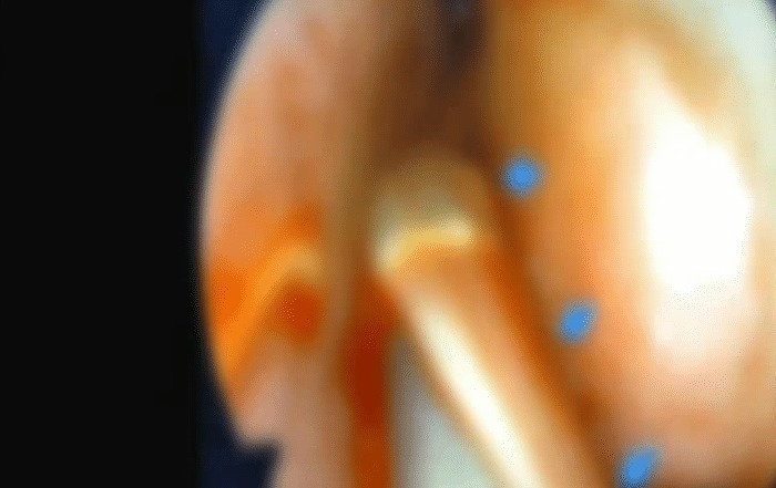 医生|小伙被大鼻涕堵的快要窒息了，医生没办法，只能用剪刀剪断了