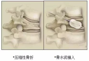 微波消融|微波消融联合骨水泥术有效治疗骨肿瘤