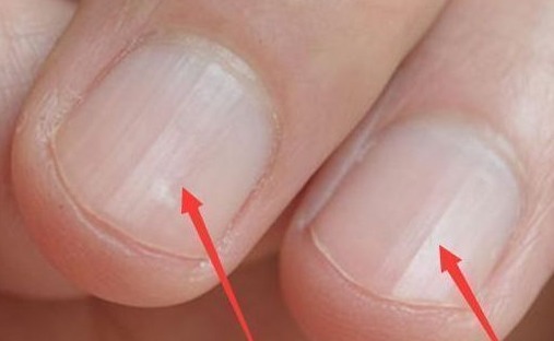 标志|肝脏好的人,手上都有这“5个标志”,看看你的手上有没有