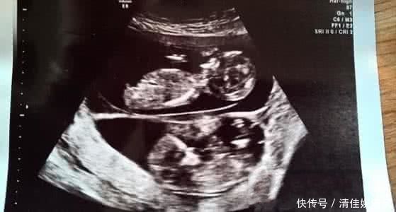 迈克尔|女子怀孕五个月后再度怀孕，医生检查过后，丈夫顿感泣不成声