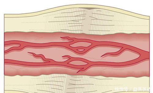 动脉粥样硬化可以逆转，一招可将血管壁清理干净，软化血管溶血栓