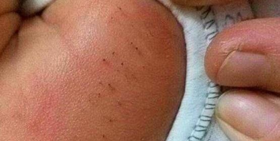 拔掉|宝宝身上长“小黑虫”,妈妈用心一颗颗拔掉,不料孩子被送去抢救