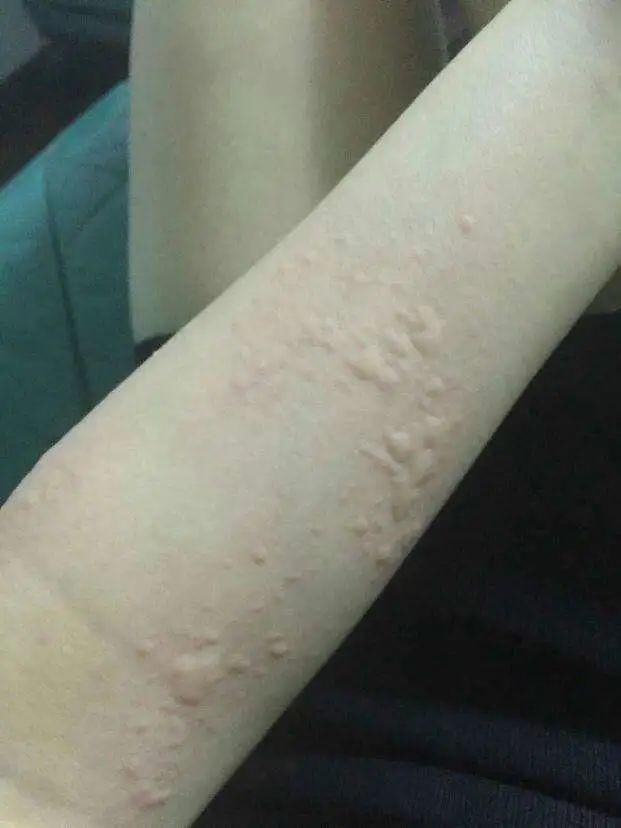  荨麻疹|荨麻疹发作起来奇痒无比，用好这几招可有效缓解
