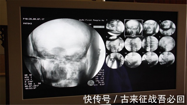 释迦牟尼$2017年,定慧寺将高僧遗体捐赠国家,体检现场显示:大脑还在