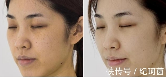 黄褐斑|大牌祛斑产品哪款最有效果?全球公认最好的祛斑产品抢先看~