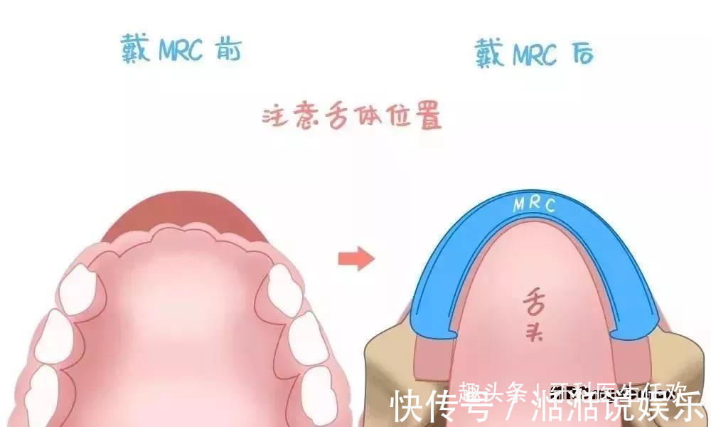 口腔|儿童这些不良习惯,是导致牙齿不齐的原因所在!