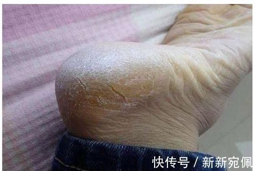 维生素|脚后跟总是干裂起皮？可能是体内疾病发出的信号，别忽视！