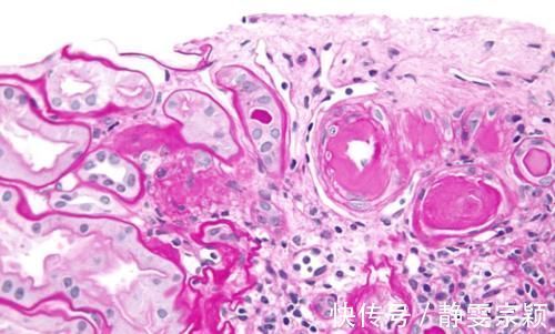 痛风性肾病|尿酸高影响肾功能吗？医生：痛风患者请做好十件事，保肾降尿酸