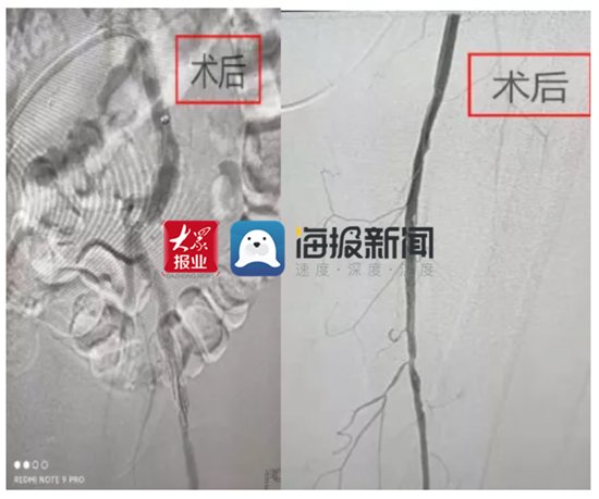 微创开通血管手到病除|万杰医院:七旬大伯腿痛难忍夜不能寐,介入微创开通血管手到病除