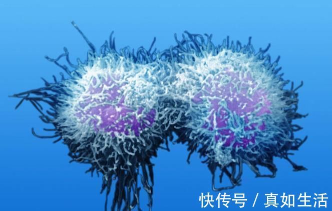 癌细胞|以下三个症状不断出现,十有八九是进展期癌症,你却一拖再拖