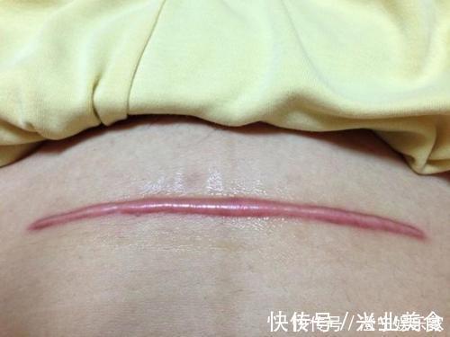 准妈妈|剖腹产的5个隐形后遗症,在生二胎时才会现形,准妈妈要谨慎考虑