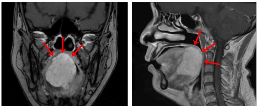 放化疗|女子做核酸检测，意外查出舌根隐藏巨大肿物！