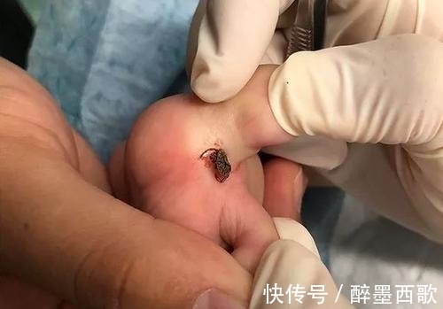 医生|“小血痂”竟然是孩子的夺命虫!医生:幸亏发现的及时