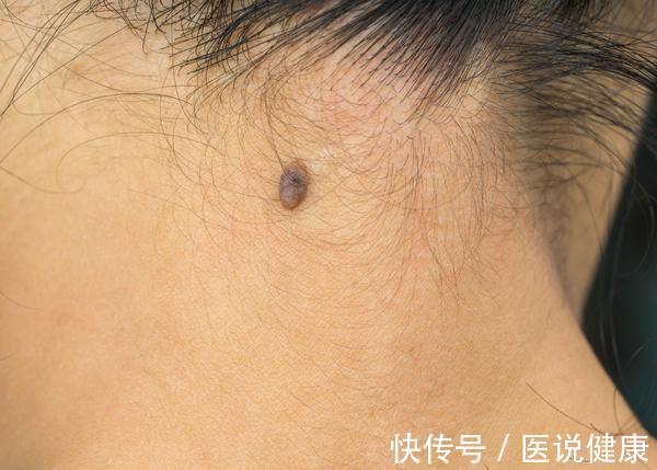 色素痣|皮肤上出现了红痣,还伴随这4种情况,当心是皮肤肿瘤找上门了
