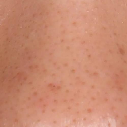 缩毛孔效果不大？对抗毛孔问题还是得来点硬的