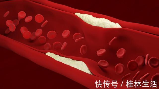 肥肉|血脂高都是肥肉造成的医生不是！这3物才是血脂的“加速器”