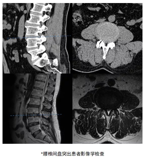 通道|“管中窥豹”，微创通道精准治疗腰椎病变