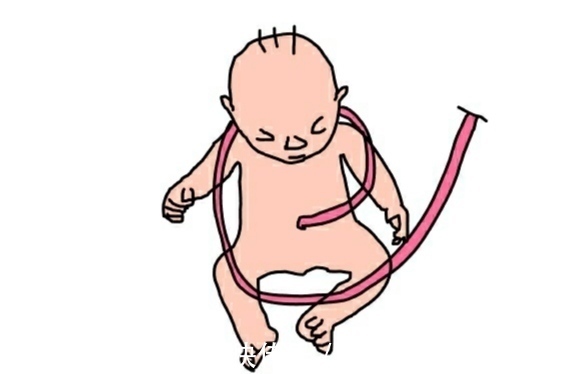 宝宝|脐带绕颈常发生在这几周，四大原因孕妈早了解，早做好预防工作
