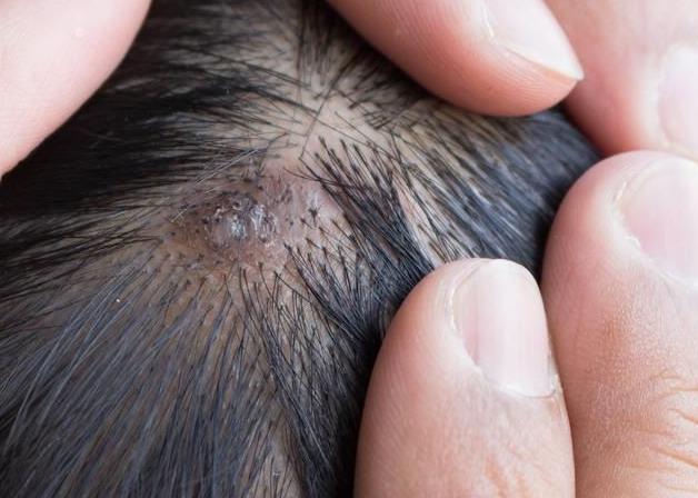 头皮长个肉疙瘩 头皮长个肉疙瘩