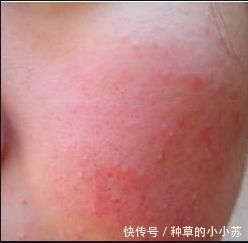 皮肤|皮肤科主任建议：敏感肌护肤牢记这几点